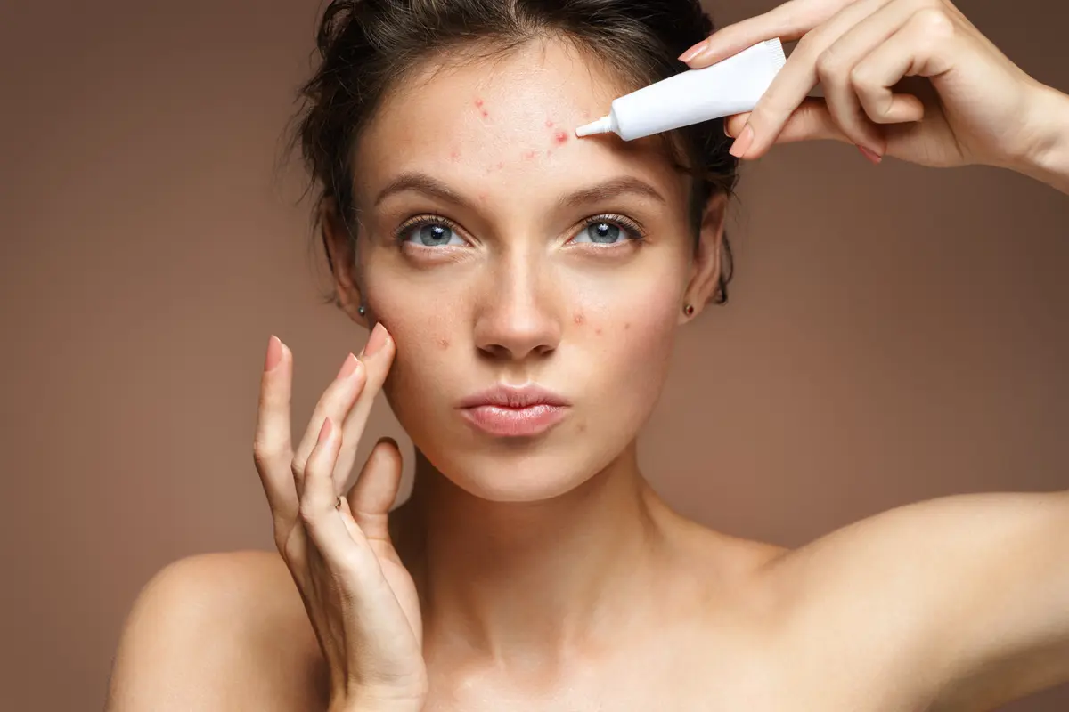 FIMELA Beauty: Acne Prone / Image: Shutterstock