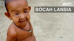 Seorang bocah yang baru berusia 4 tahun mengalami penyakit aneh. Wajah dan kulit di tubuhnya mengendur sehingga tampak seperti kakek-kakek