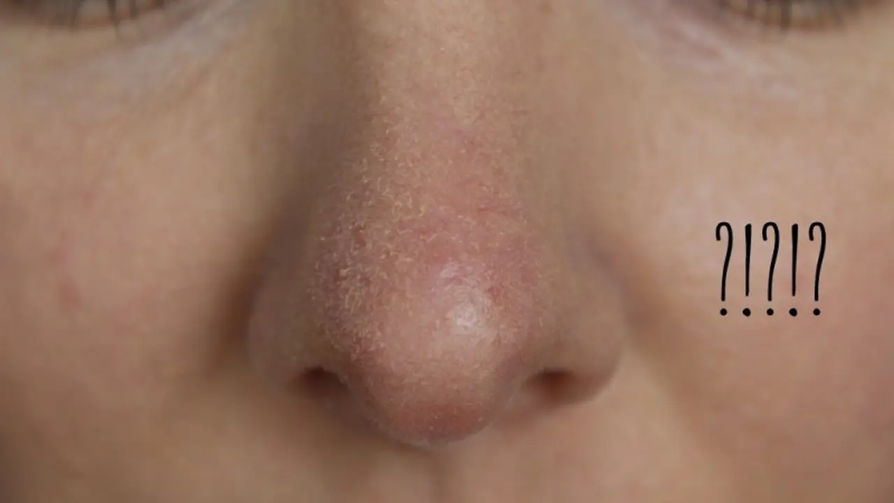 Alami Kekeringan Kulit di Sekitar Hidung? Ini Solusinya. Source: Mugeek Vidalondon