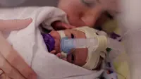 Kisah Haru Perjuangan Bayi Ward yang Lahir Prematur