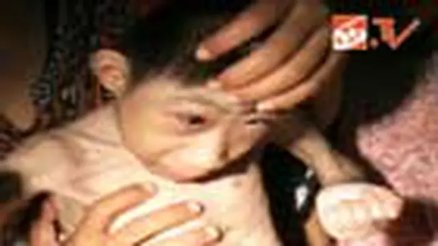 Bocah di Medan Menderita Penyakit Aneh