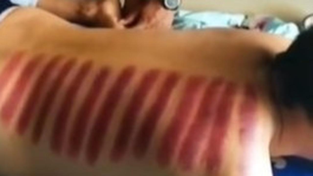 Benarkah Kerokan Bisa Mengeluarkan Angin Berlebih di Dalam Tubuh?