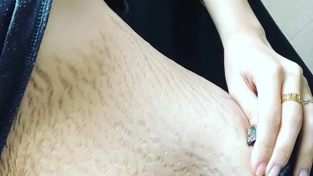 [Bintang] Stretch Mark