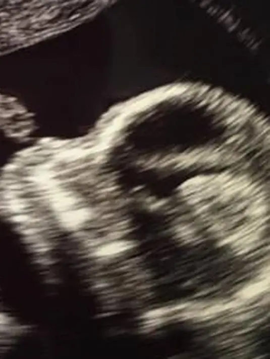 Seperti yang dikutip dari E!Online, Blac dan Rob merasa sangat bersyukur dan bahagia dengan perkembangan benih cinta mereka. Tak lupa juga, Blac unggah foto USG di akun socmednya. (blacchyna/Bintang.com)