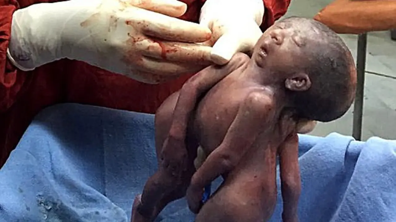 Ngeri, Bayi Kembar Siam Ini Lahir dengan Satu Kepala