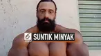 Meski telah diperingatkan dokter tentang risiko menggunakan minyak synthol secara teratur. Namun, Seorang pria di Brasil malah mengabaikannya dan terus menggunakannya secara rutin. Dia bahkan berniat untut menjadikan otot-ototnya lebih besar lagi.