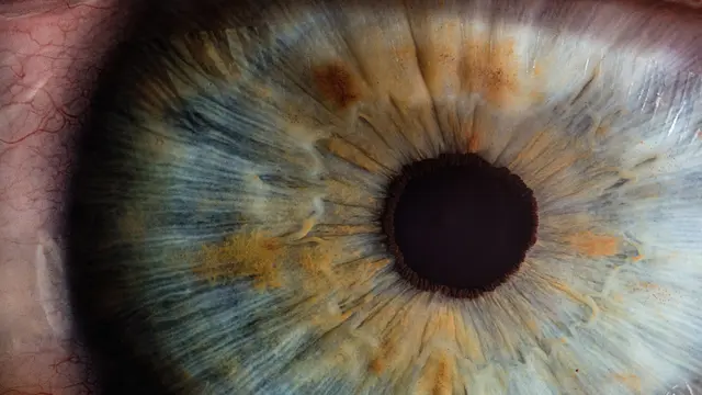 Ciri Retinoblastoma