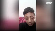 Pria ini bisa mengluarkan bola matanya hingga 10 mm.