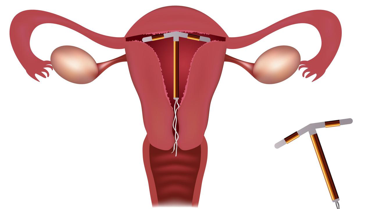 Ahli Kandungan Harus Tahu Cara Pasang Kontrasepsi IUD