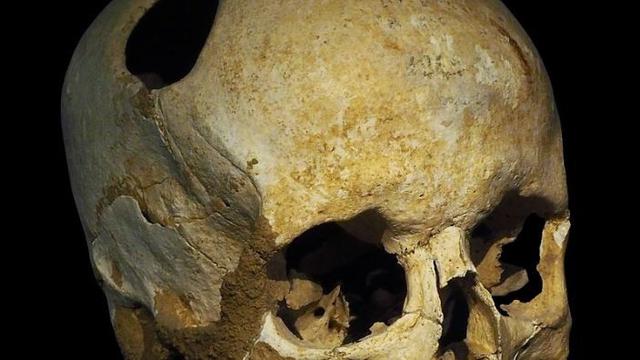 Ilustrasi tengkorak yang pernah melakukan trepanasi (Wikimedia Commons)