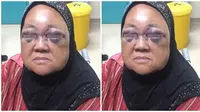 Nenek 69 alami cidera parah di bagian mata (Sumber: kosmo)