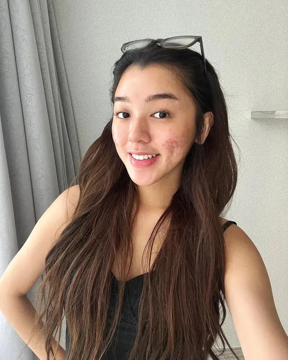 6 Potret Wajah Gabriella Ekaputri Berjerawat, Tetap Percaya Diri Tampil Natural