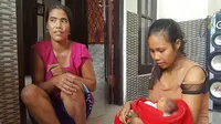 Bayi tanpa tempurung kepala yang lahir di Desa Tejakula, Bali, butuh bantuan. (Eka Prasetya/Radar Bali/Jawapos)