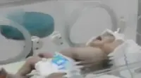VIDEO: Orangtua Bayi Perempuan Berkepala Dua di Gresik Pasrah