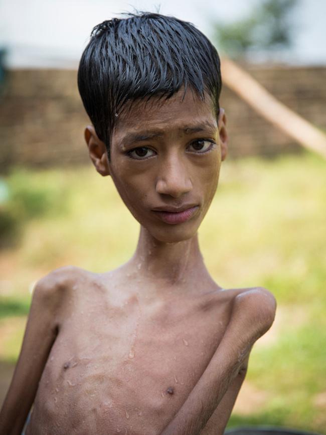 Ahirwar adalah seorang anak dengan kepala miring sebelum ia melakukan operasi | Photo: Copyright dailymail.co.uk