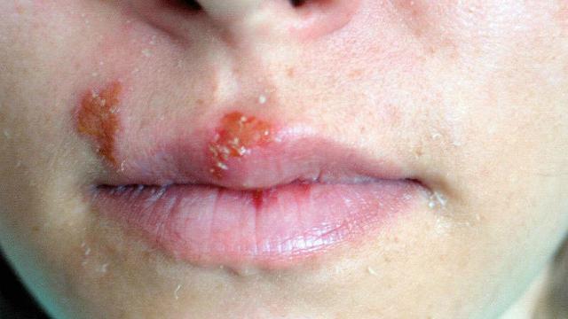 herpes simplex okoz e fogyást
