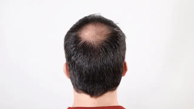 Apa Itu Alopesia dan Bagaimana Cara Menanganinya?