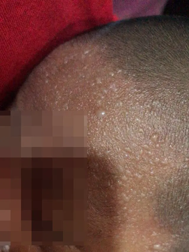 Balita Terinfeksi Penyakit Kulit Setelah Disentuh Kerabat