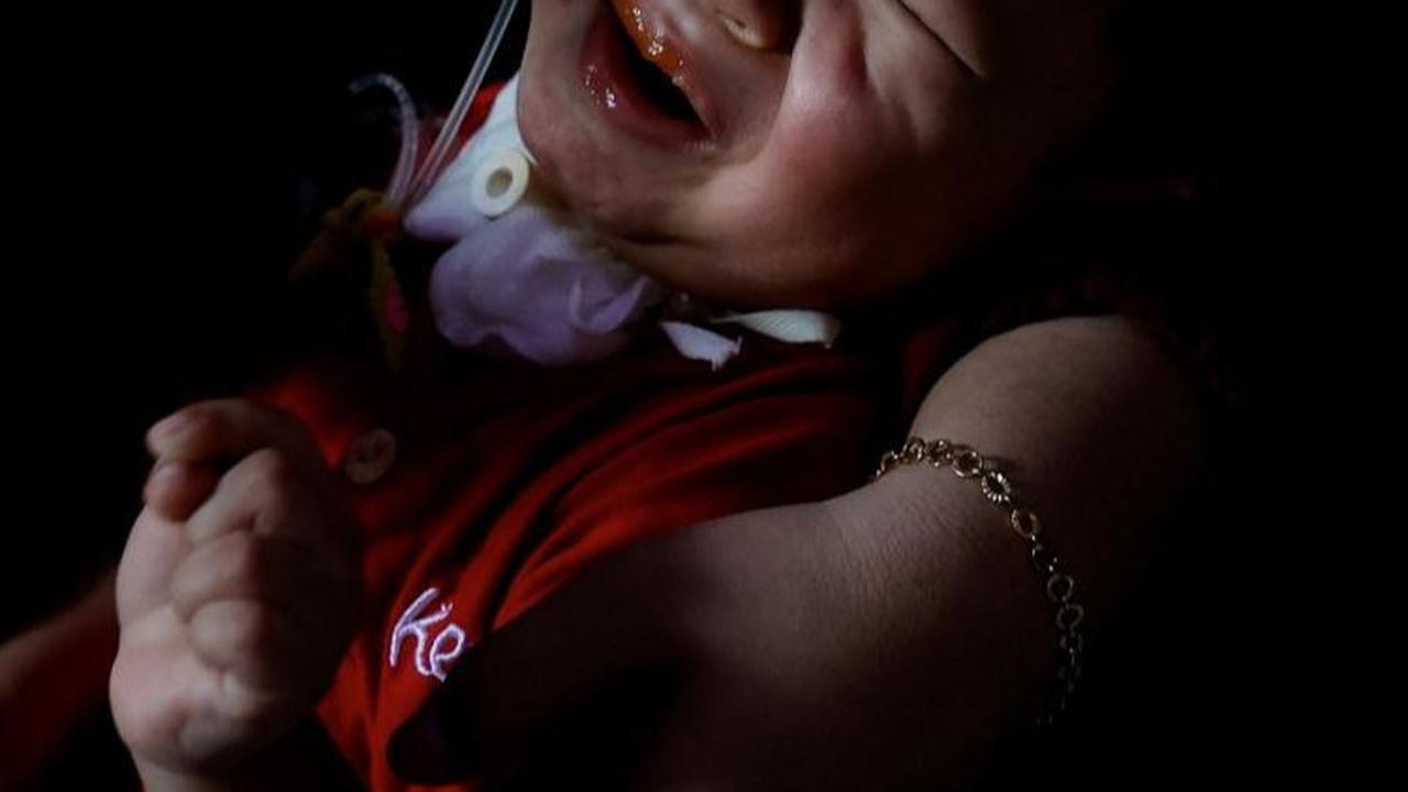 FOTO: Kisah Penderitaan Anak-Anak Gagal Ginjal Akut di Indonesia Berjuang Hidup Setelah Keracunan Obat Sirup