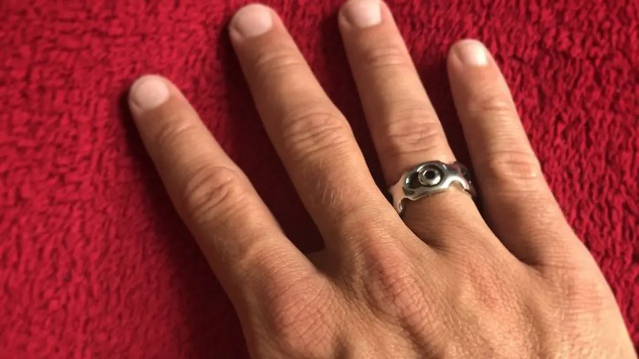 [Bintang] Kreatif! Pria Ini Bikin Cincin dari Logam Penyangga Patah Tulang