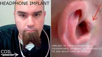 Pria Ini Nekat Implan Headphone di Telinganya
