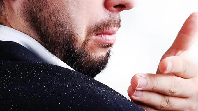 4 Bahan Dapur Ini Bisa Hilangkan Ketombe