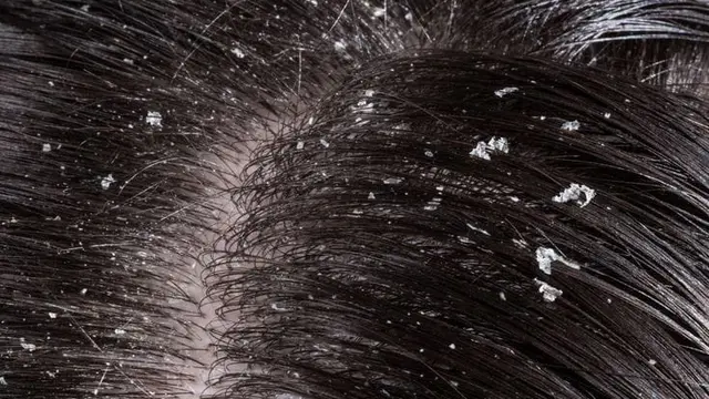Rambut dengan Ketombe