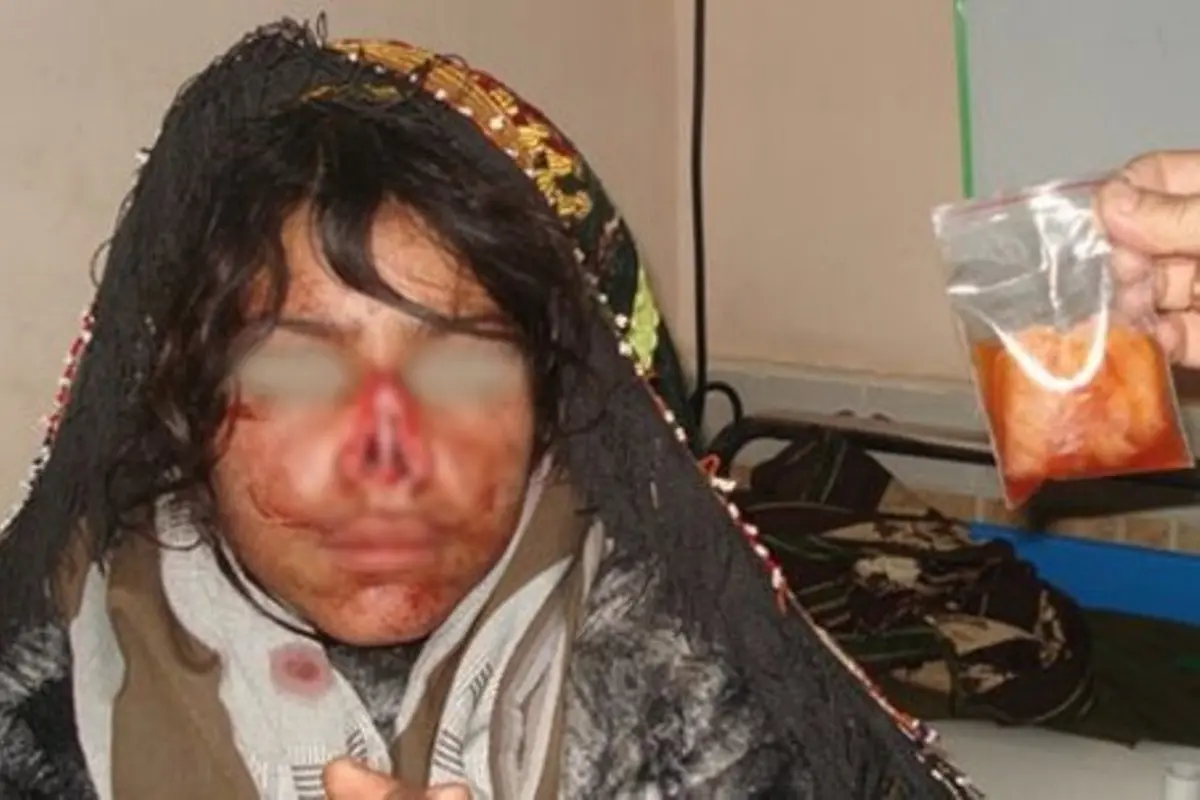 Sadis! Hidung Perempuan Ini Ditebas Habis oleh Suaminya