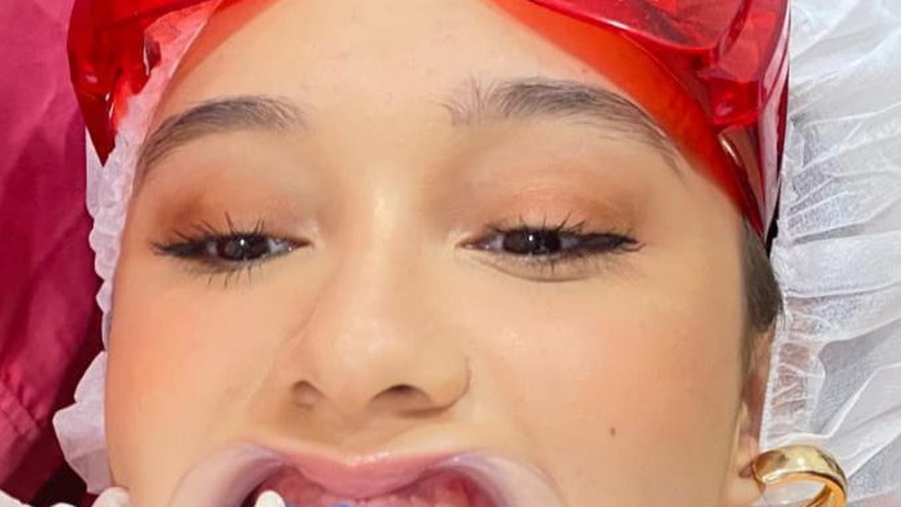 "Mau treatment Mouth Rehabilitation, biar tambah percaya diri aja," ujar Yasmin Napper.