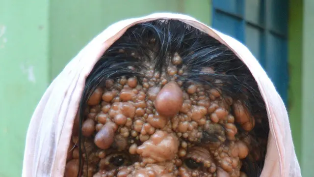Hidup Tersiksa dengan Ratusan Tumor, Nenek bak Monster Ingin Tuhan Ambil Nyawanya