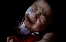 FOTO: Kisah Penderitaan Anak-Anak Gagal Ginjal Akut di Indonesia Berjuang Hidup Setelah Keracunan Obat Sirup