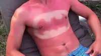 Para onliner rela terkena kanker kulit demi mengikuti tren Sunburn Art di sosial media.