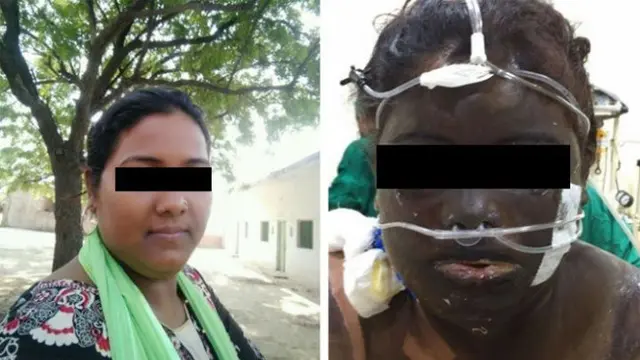Kesal Istri dapat Pekerjaan, Suami Siram Wajahnya dengan Air Keras