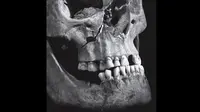 Cedera pada Kerangka Raja Inggris Richard III (Appleby, et al. Perimortem trauma in King Richard III: a skeletal analysis. The Lancet)