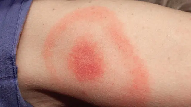 Lyme Disease