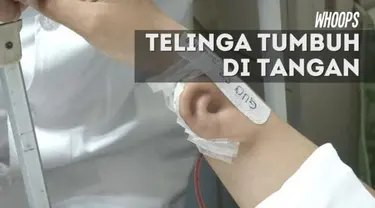 Nantinya telinga itu akan ditransplantasikan ke kepala Ji. Dengan begitu, kondisi fisik Ji bisa kembali seperti semula.