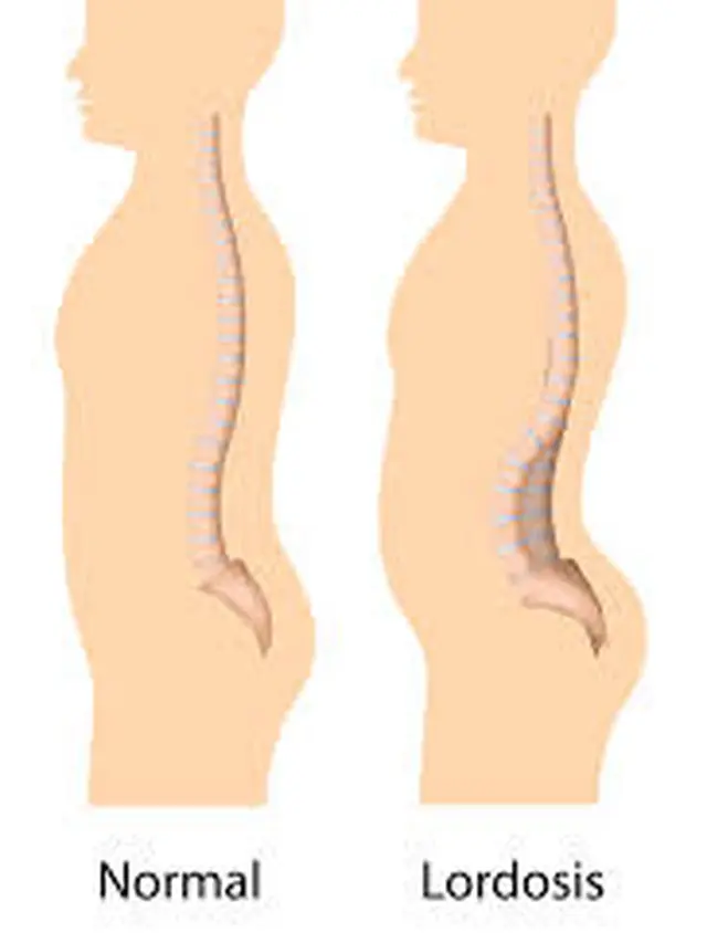 lordosis