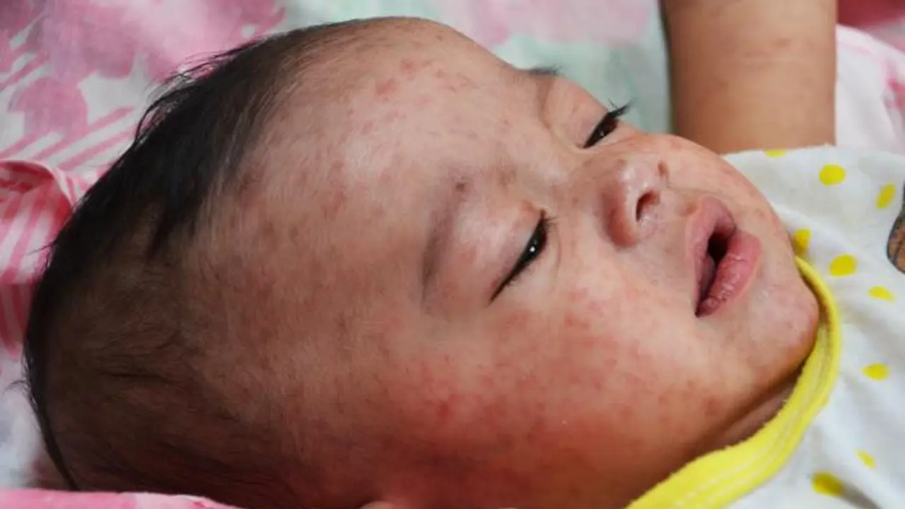 Penyakit Tampek pada Bayi
