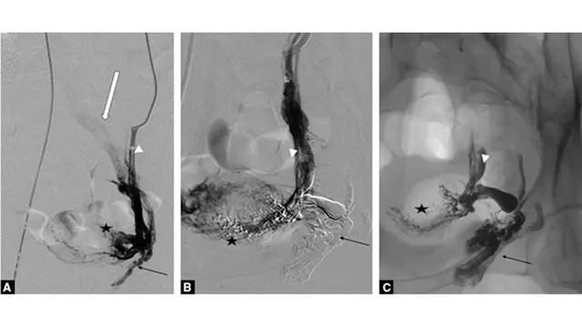 Diagnosa Melalui Venogram