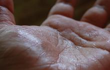 Mengapa Tangan dan Kaki Berkeringat? Tinjauan Medis di Balik Hiperhidrosis