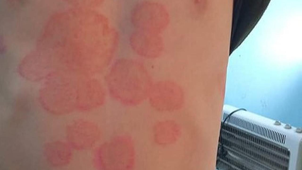 Berbagai Faktor Risiko yang Perlu Dihindari Agar Tidak Tertular Kurap