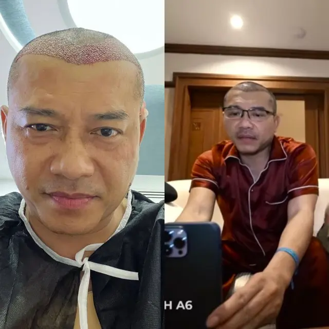 Potret Transformasi 6 Artis Usai Jalani Transplantasi Rambut, Kevin Aprilio-Atta Halilintar
