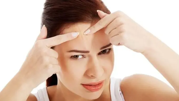 Jerawat di jidat./Copyright shutterstock.com