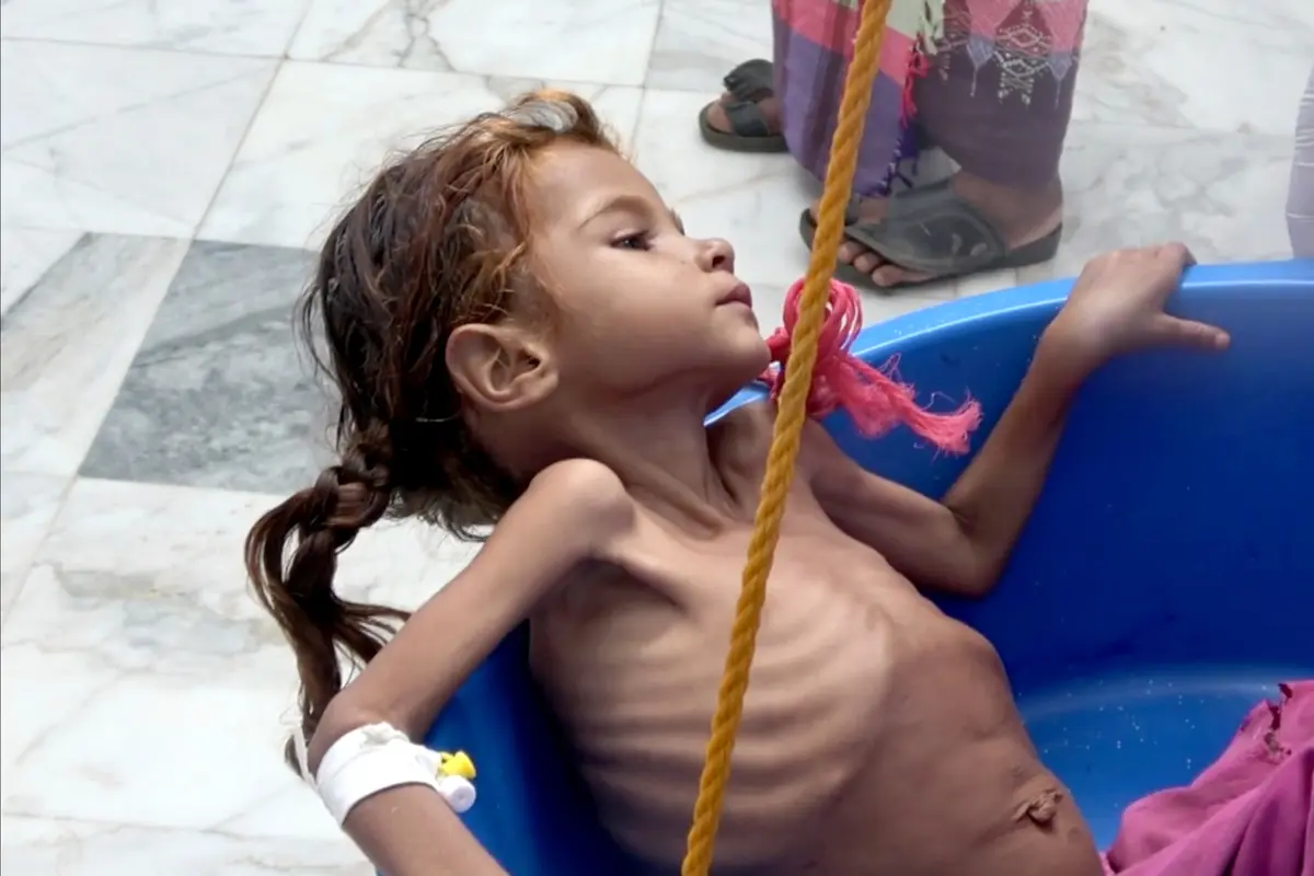 Perang Panjang, 5 Juta Lebih Anak Yaman Terancam Kelaparan Akut
