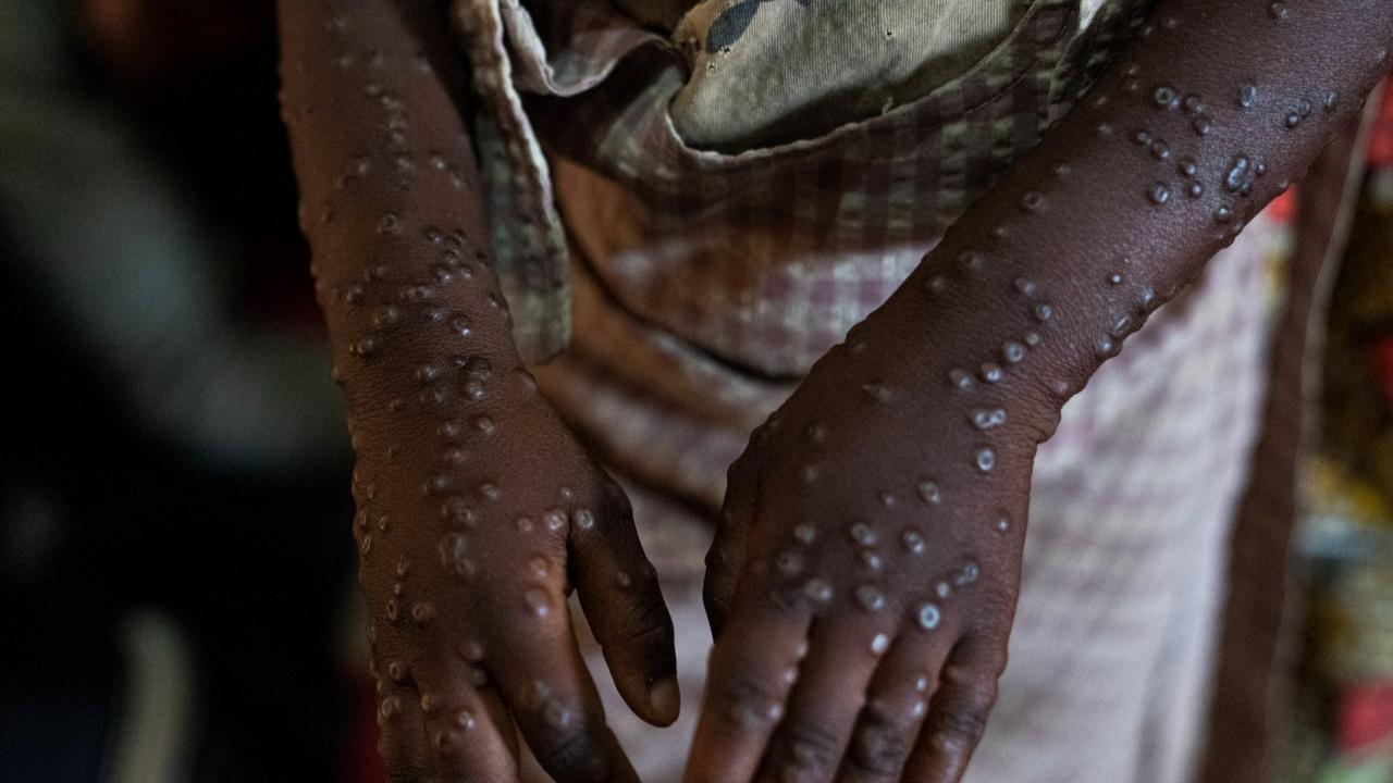 Pembesaran Kelenjar Getah Bening Jadi Ciri Khas Bedakan Mpox dengan Penyakit Lainnya