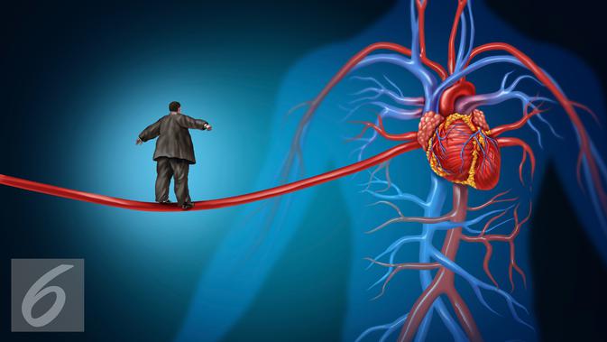 Cara penanganan penyempitan pembuluh darah pada pasien jantung koroner. (iStockphoto)