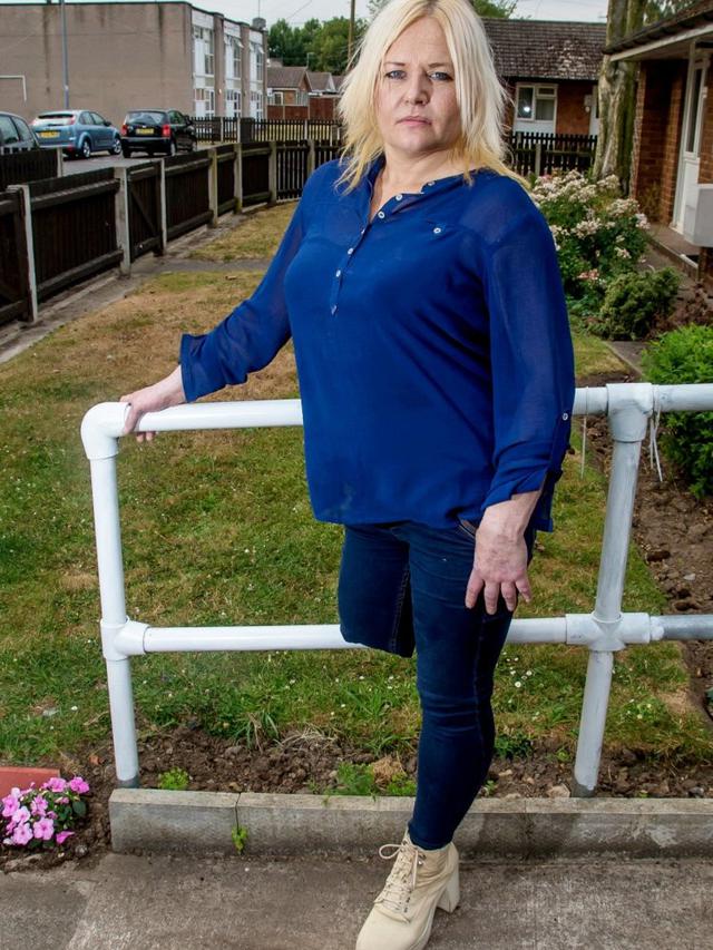 Terluka Saat Mencukur Bulu Kaki, Wanita Ini Terpaksa Diamputasi