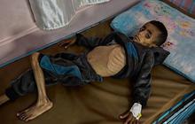 Tak Ada Air Bersih dan Susu, Anak-Anak Gaza Kena Wabah Meningitis