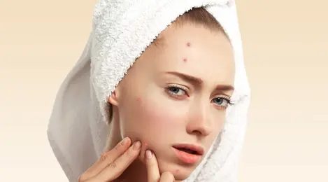 4 Kandungan Skincare yang Paling Ampuh untuk Basmi Jerawat