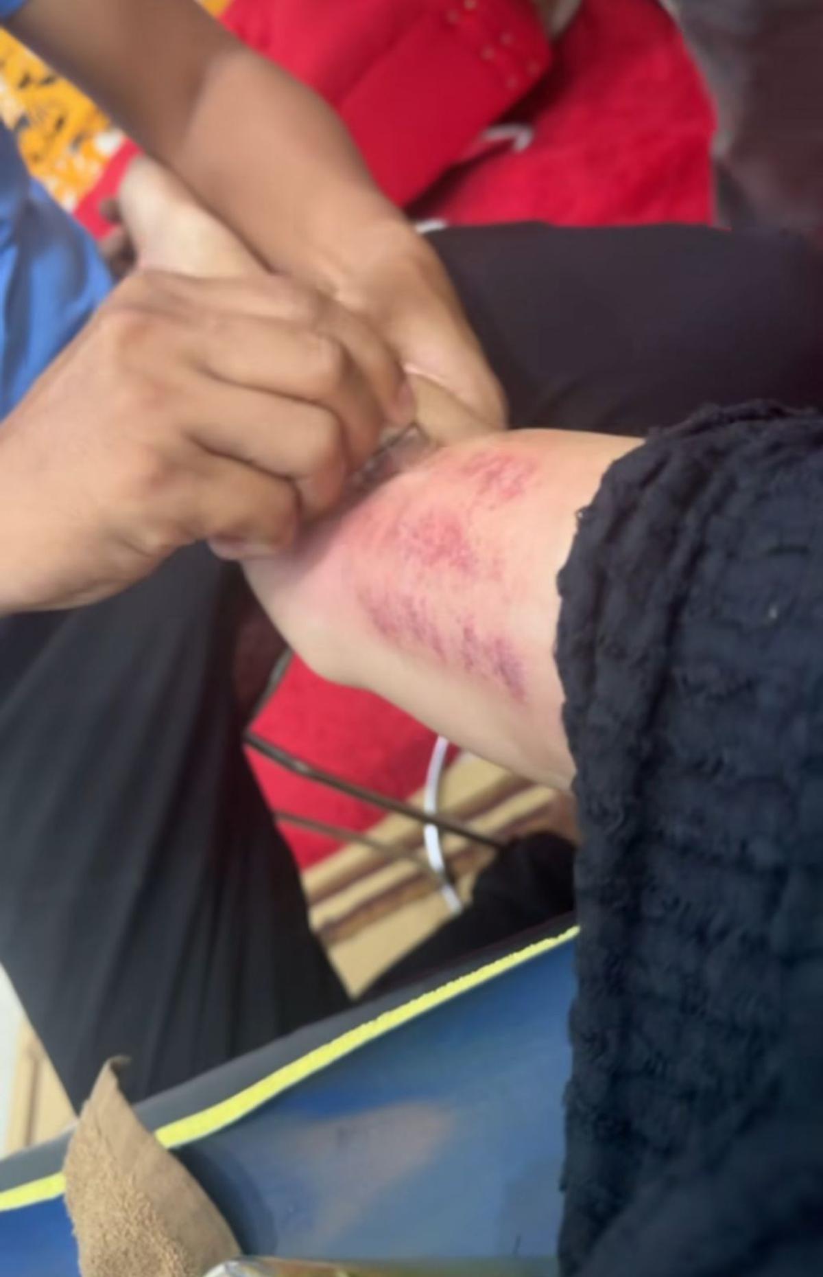 Aisar Khaled Jalani Kerokan Sepulang dari Rumah Sakit, Begini Kondisinya